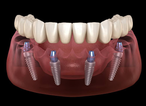 How All-on-4 Dental Implants Work