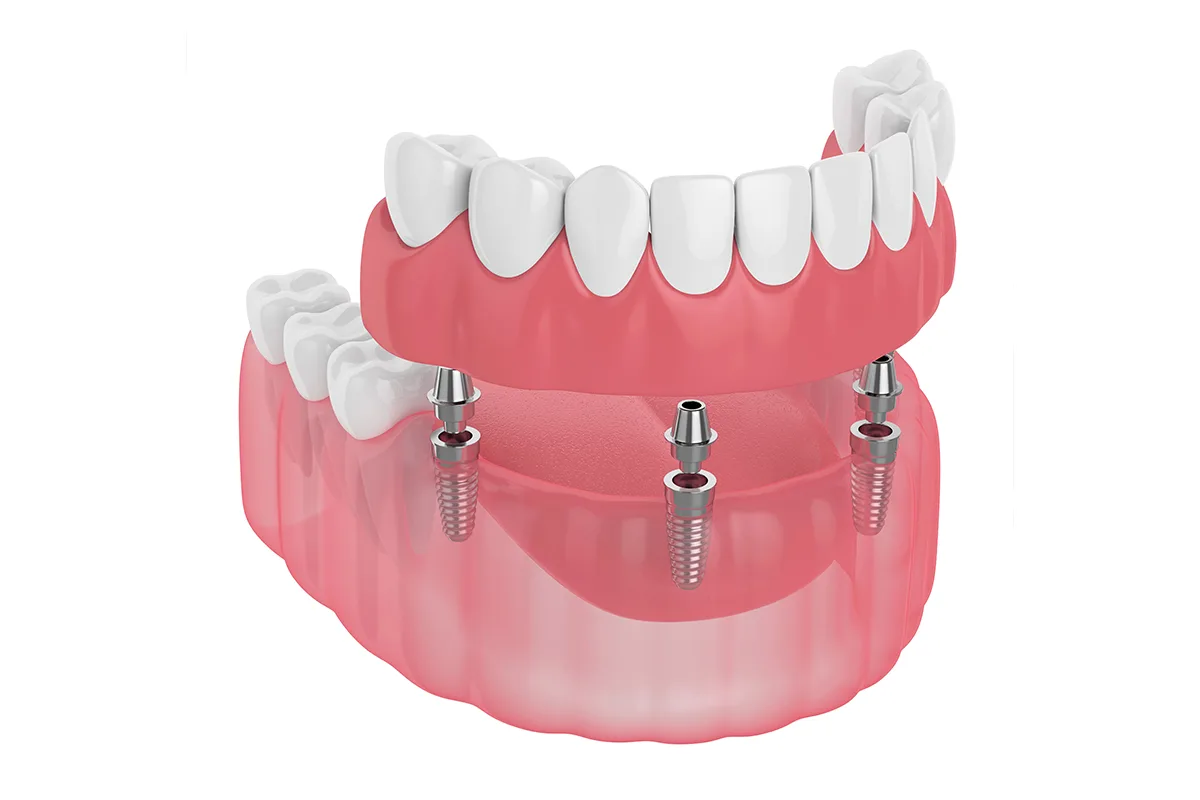 Implant supported Dentures Whitlow Dental Care in Fresno offers implant supported dentures for a secure and natural-looking smile.