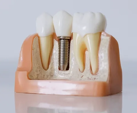 Get special pricing on dental implants at Whitlow Dental Care in Fresno. Enhance your smile today!